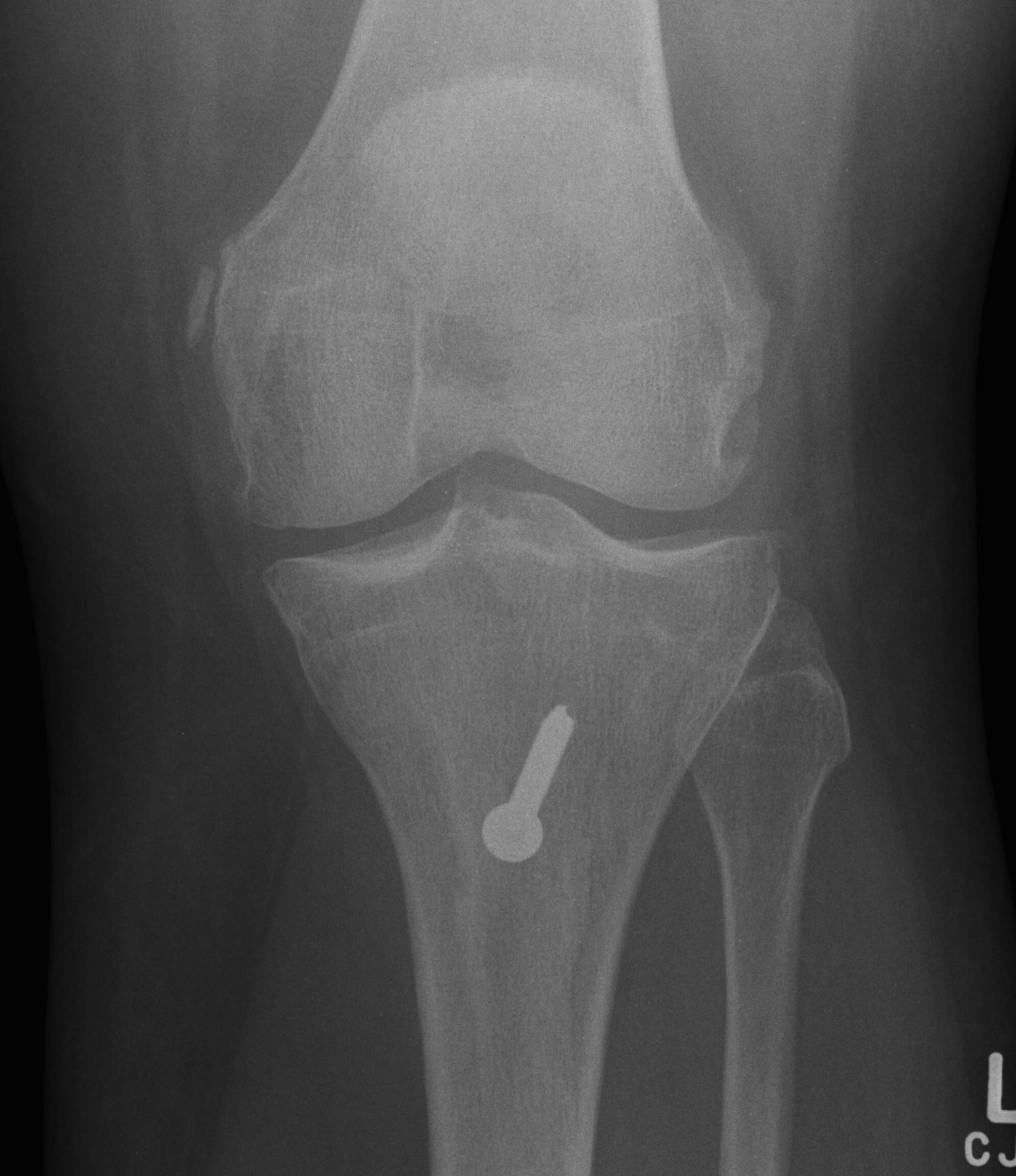 Fulkerson Osteotomy AP